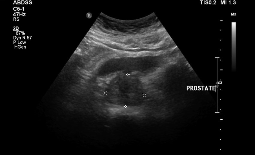 Ultrazvuková prostatitida před přijetím zxcvbnmqwert