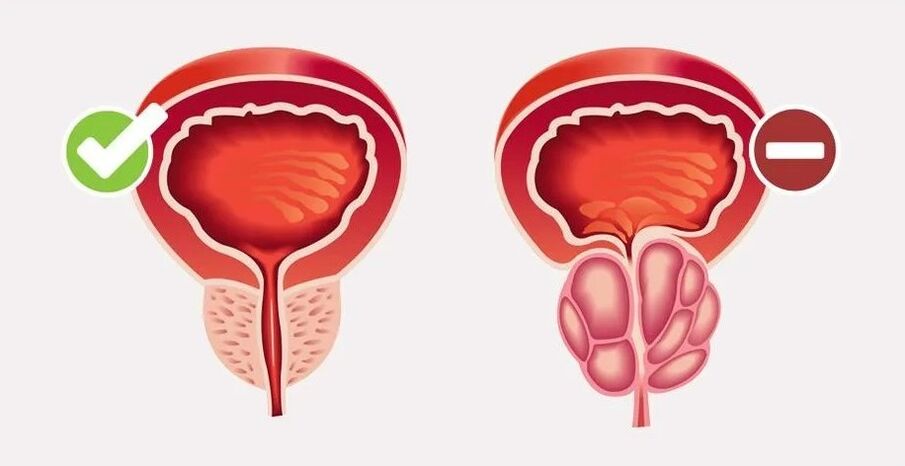 Prostatitida u mužů
