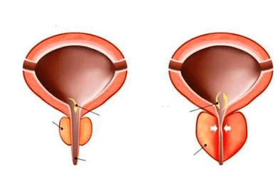 Co je akutní prostatitida