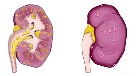 K čemu je akutní prostatitida